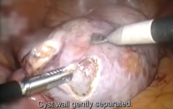 Gently separate the cyst wall
