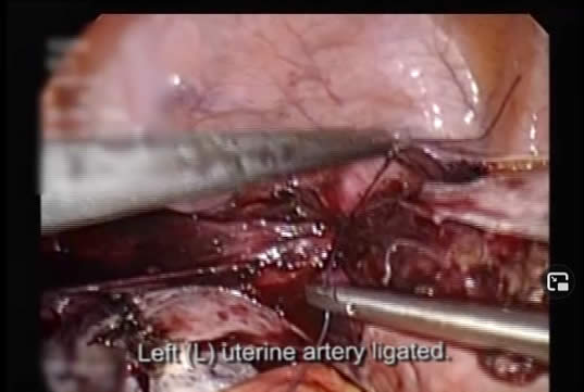 left uterine artery ligated