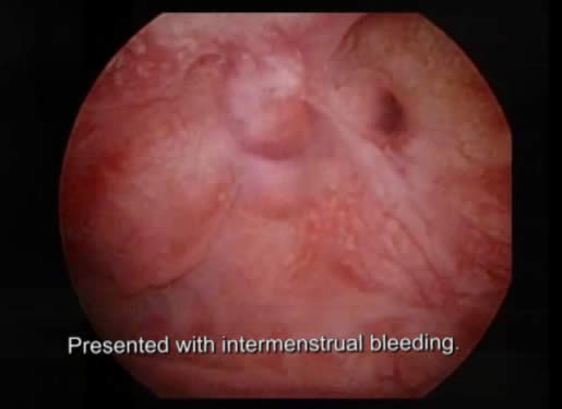 Transcervical Resection of Endometrial Polyps