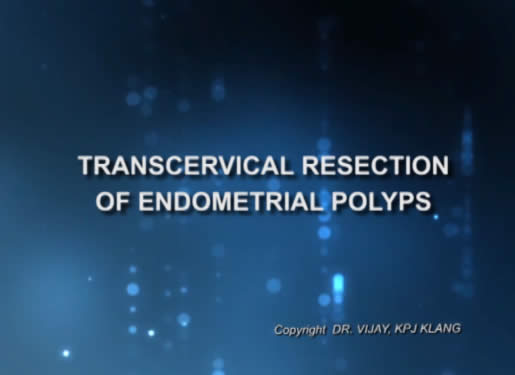 Transcervical Resection of Endometrial Polyps