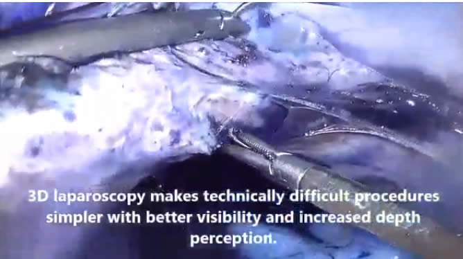 3D Laparascopy Surgery